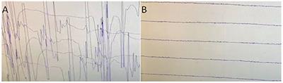 Progressive Encephalomyelitis With Rigidity and Myoclonus With Thymoma: A Case Report and Literature Review